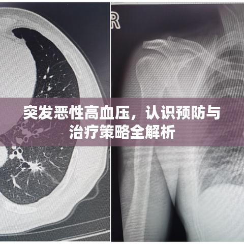 突发恶性高血压，认识预防与治疗策略全解析